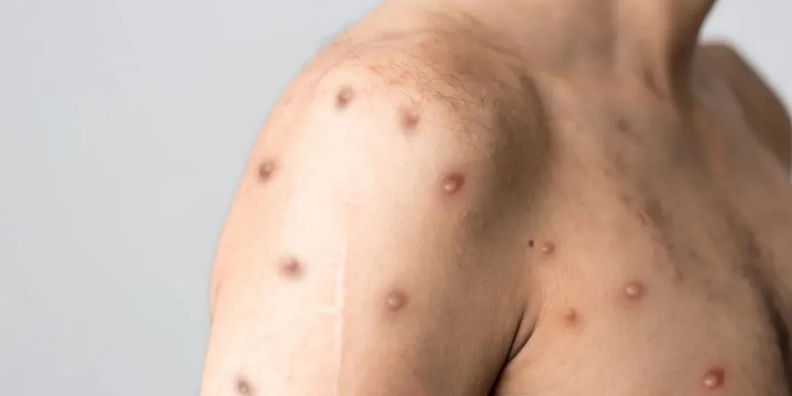Saúde reforça alerta para Mpox e orienta população sobre sintomas