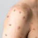 Saúde reforça alerta para Mpox e orienta população sobre sintomas