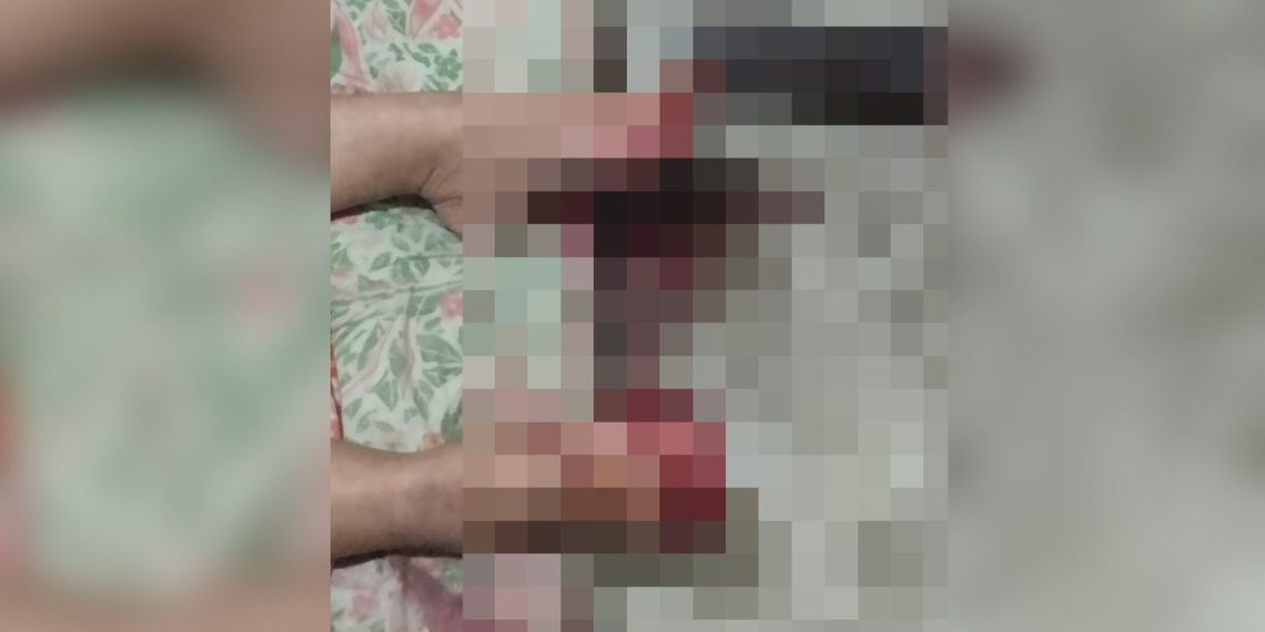 Morre mulher que teve dedos decepados pela filha em Itaperuna