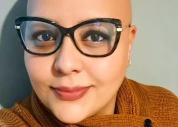 Pacientes com alopecia areata contam trajetória para reaver autoestima