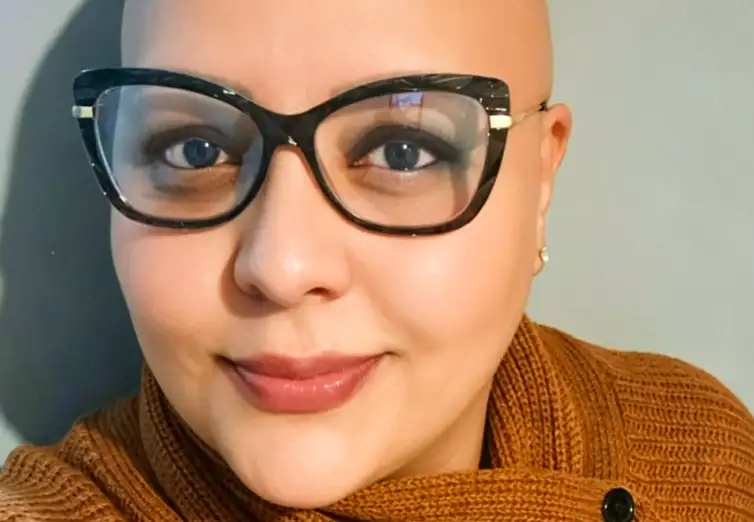 Pacientes com alopecia areata contam trajetória para reaver autoestima
