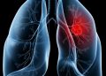 Saiba o que é adenocarcinoma pulmonar, câncer que atinge o papa